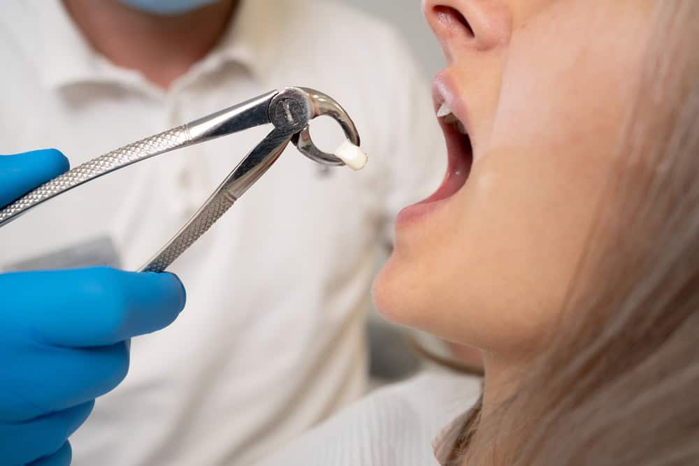 Wisdom Teeth Extraction: When and Why